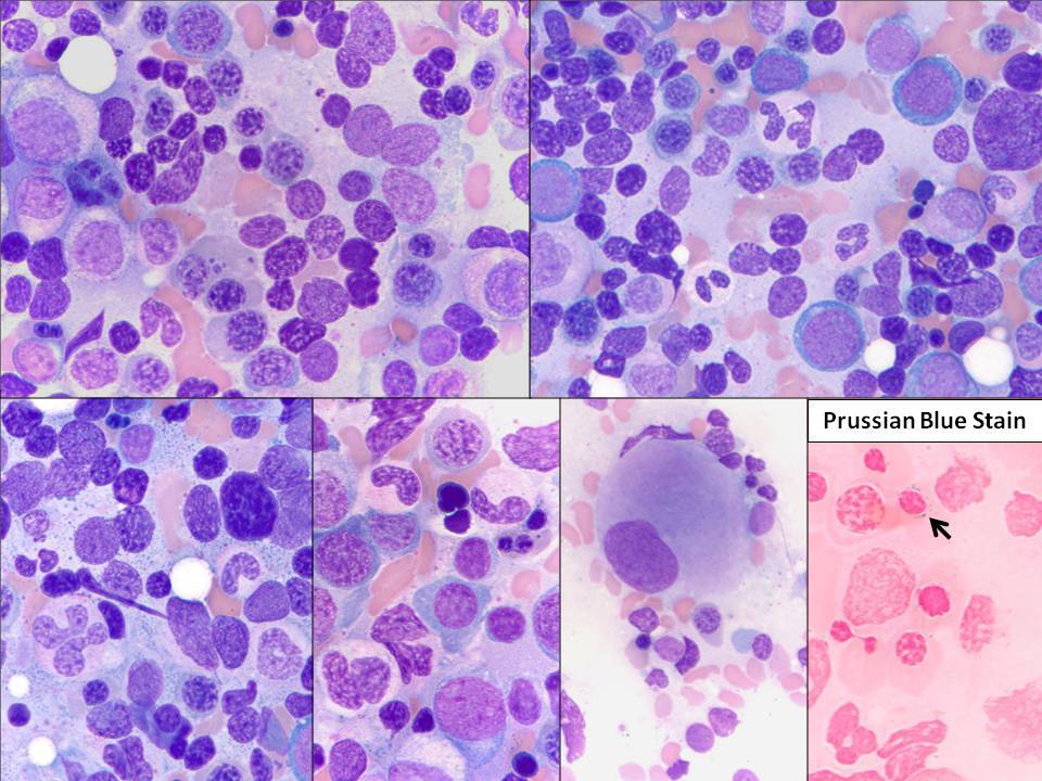 Bone marrow aspirate #1: There is dyserythropoiesis with nuclear budding and karyorrhexis. An iron stain shows rare ring sideroblasts. Occasional myeloid cells appear hypogranular, and some megaloblastoid and pseudo-Pelger-Huet forms are also seen. Some megakaryocytes are small and hypolobated.